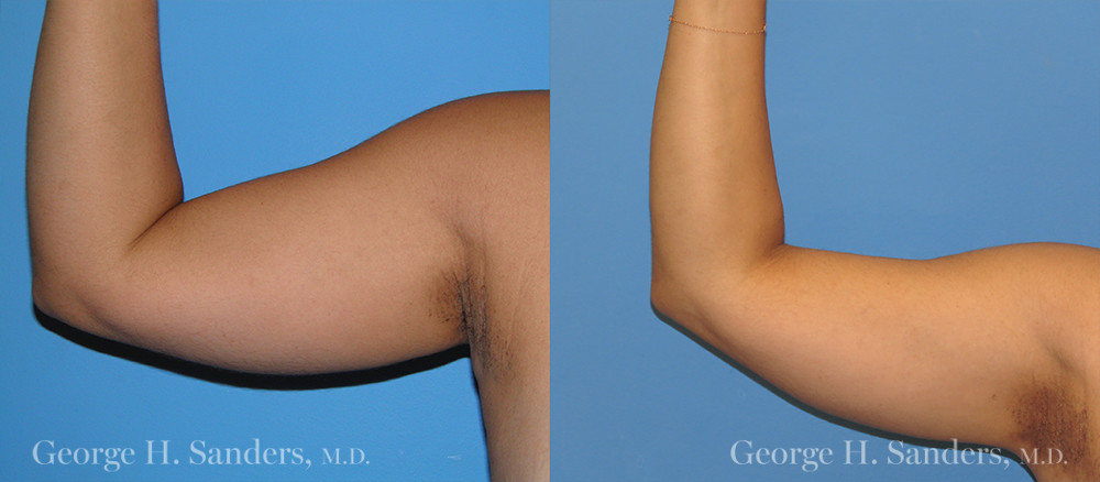 Liposuction Before and After Pictures Case 176, Los Angeles, CA